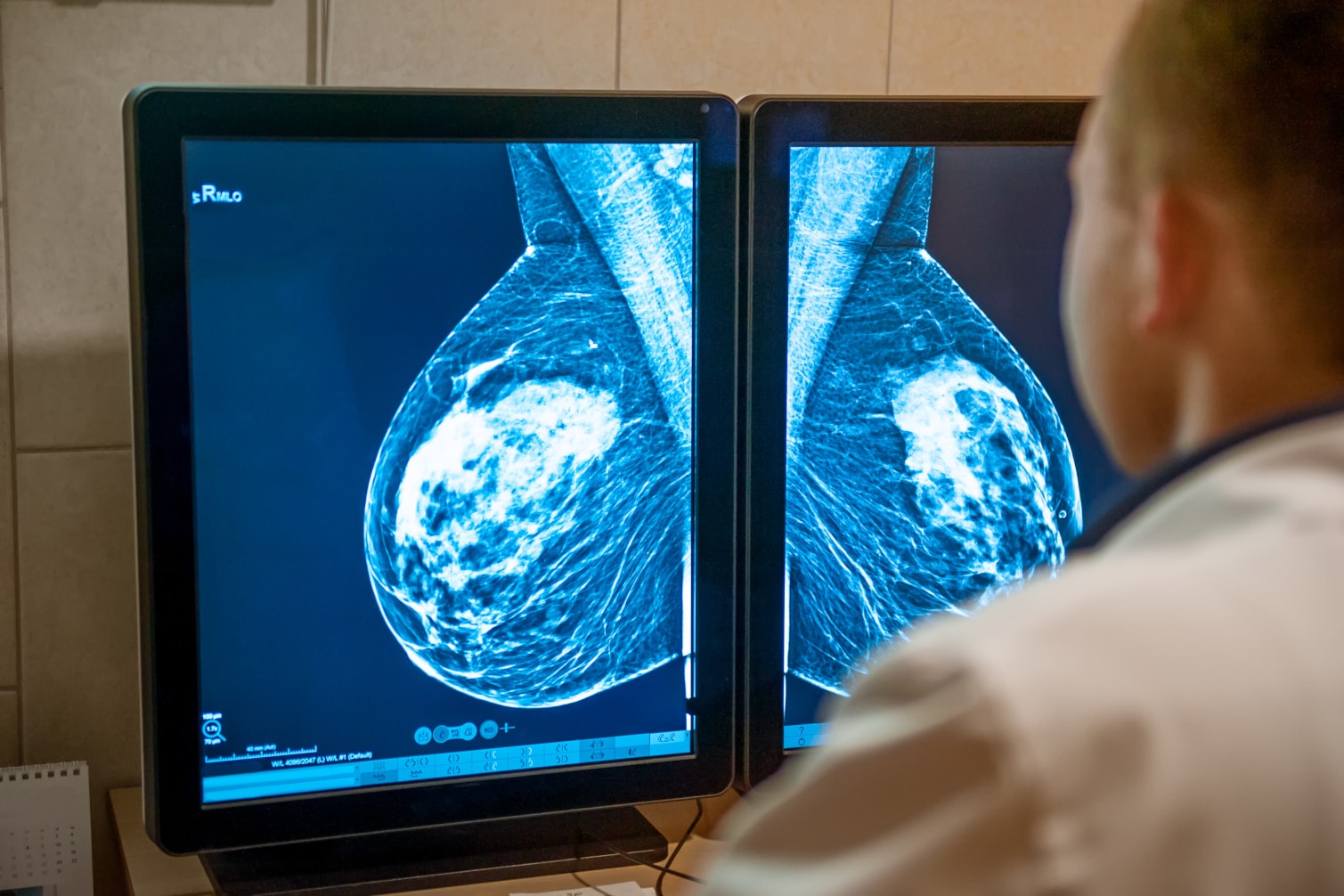 4 Ways to Reduce Your Breast Cancer Risk